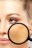 MACCHIE E MELASMA