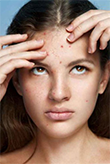 TERAPIA DELL'ACNE
